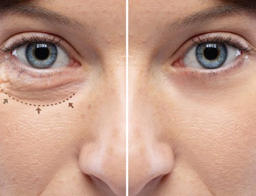Rasgado de ojos en Santander y su diferencia con la blefaroplastia y el lifting de cejas