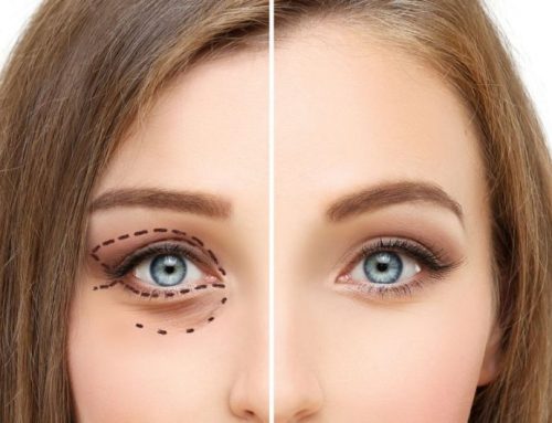 Blefaroplastia en Santander, cuándo es estética y cuándo mejora la visión